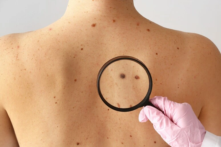 Melanoma, primo vaccino 'su misura' riduce il rischio di recidiva del 42%